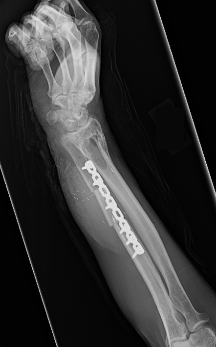 Free Tissue Transfers For Extremity Reconstruction